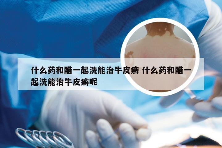什么药和醋一起洗能治牛皮癣 什么药和醋一起洗能治牛皮癣呢