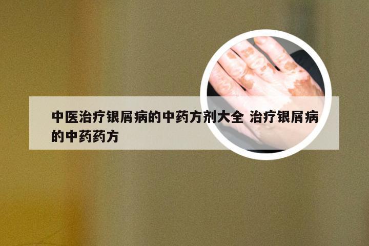 中医治疗银屑病的中药方剂大全 治疗银屑病的中药药方