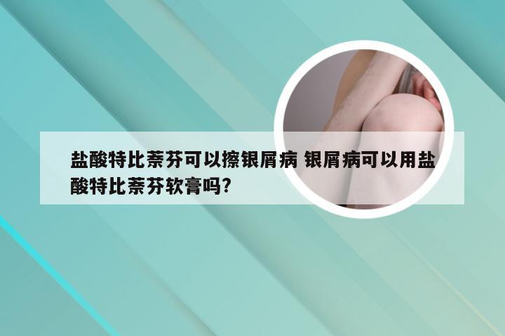 盐酸特比萘芬可以擦银屑病 银屑病可以用盐酸特比萘芬软膏吗?