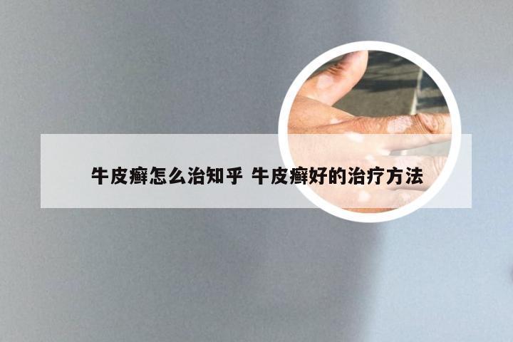 牛皮癣怎么治知乎 牛皮癣好的治疗方法