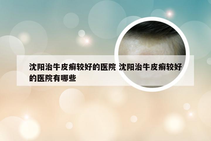 沈阳治牛皮癣较好的医院 沈阳治牛皮癣较好的医院有哪些