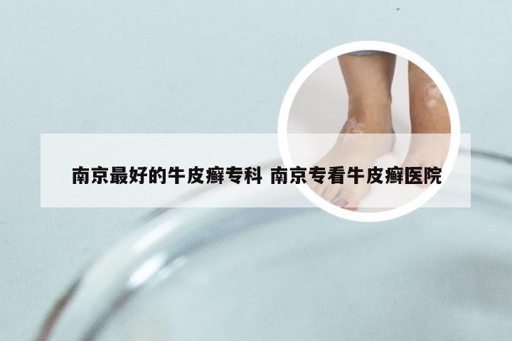 南京最好的牛皮癣专科 南京专看牛皮癣医院