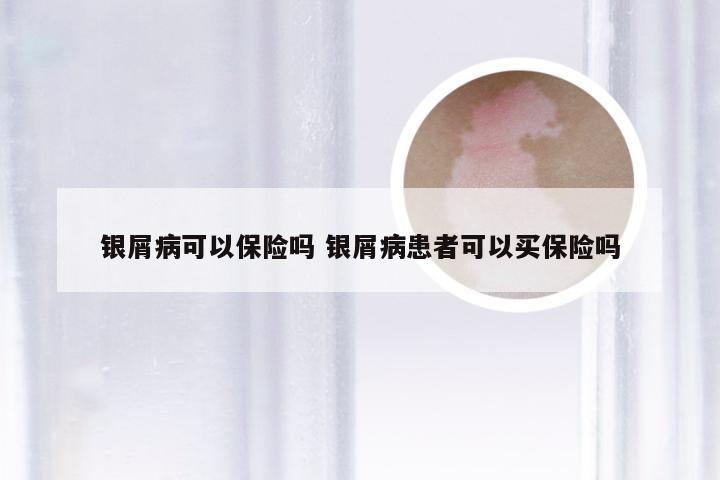 银屑病可以保险吗 银屑病患者可以买保险吗