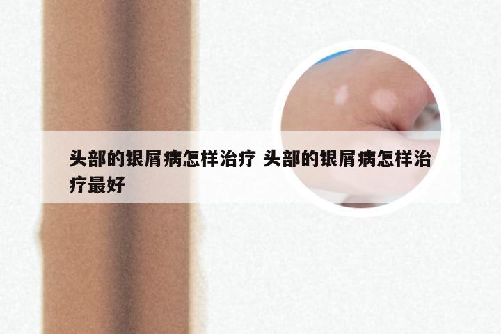头部的银屑病怎样治疗 头部的银屑病怎样治疗最好