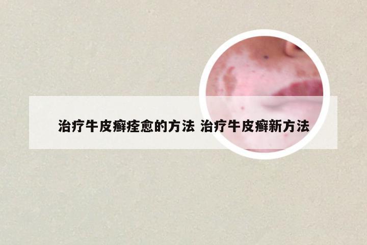 治疗牛皮癣痊愈的方法 治疗牛皮癣新方法