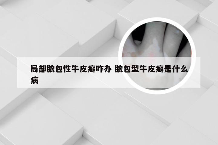 局部脓包性牛皮癣咋办 脓包型牛皮癣是什么病