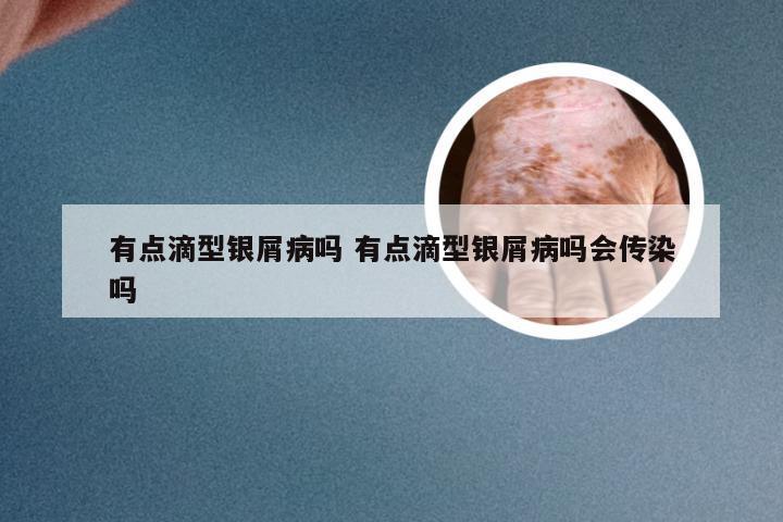 有点滴型银屑病吗 有点滴型银屑病吗会传染吗