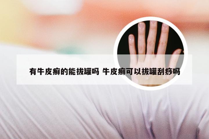 有牛皮癣的能拔罐吗 牛皮癣可以拔罐刮痧吗