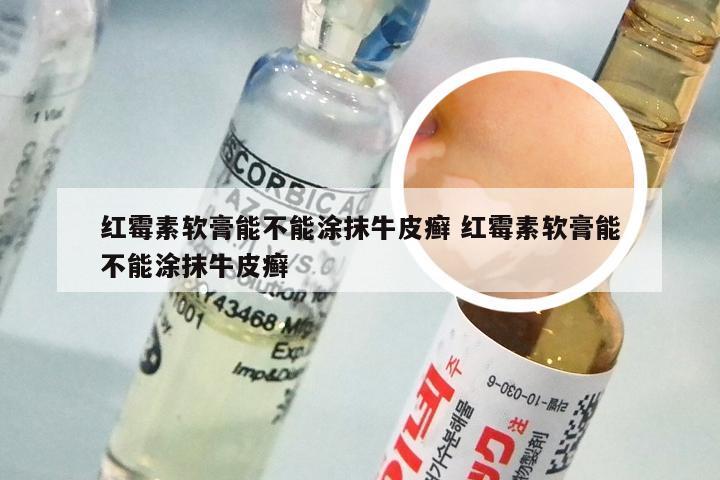 红霉素软膏能不能涂抹牛皮癣 红霉素软膏能不能涂抹牛皮癣