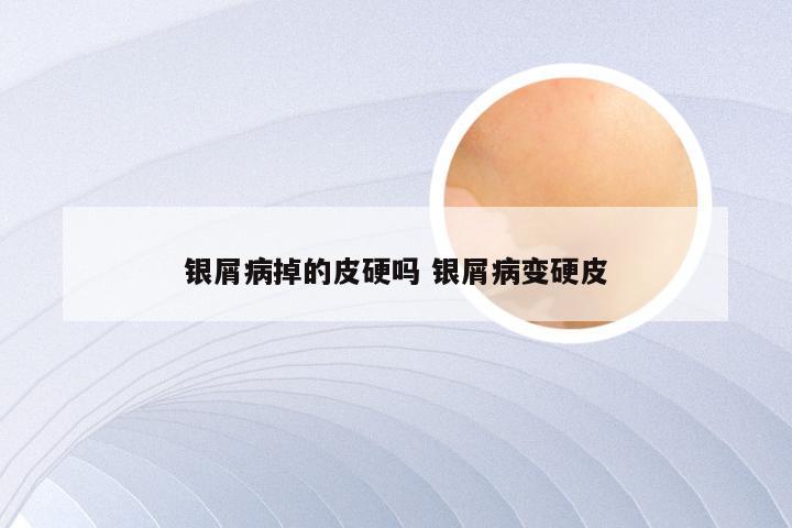 银屑病掉的皮硬吗 银屑病变硬皮