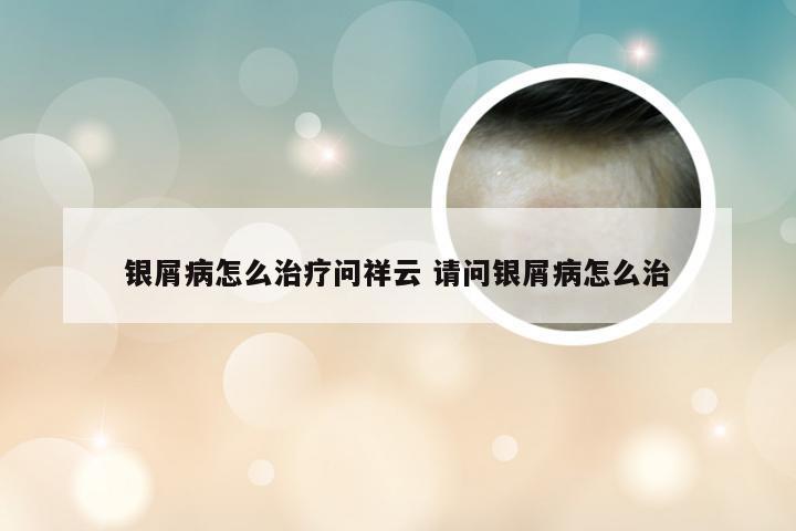 银屑病怎么治疗问祥云 请问银屑病怎么治