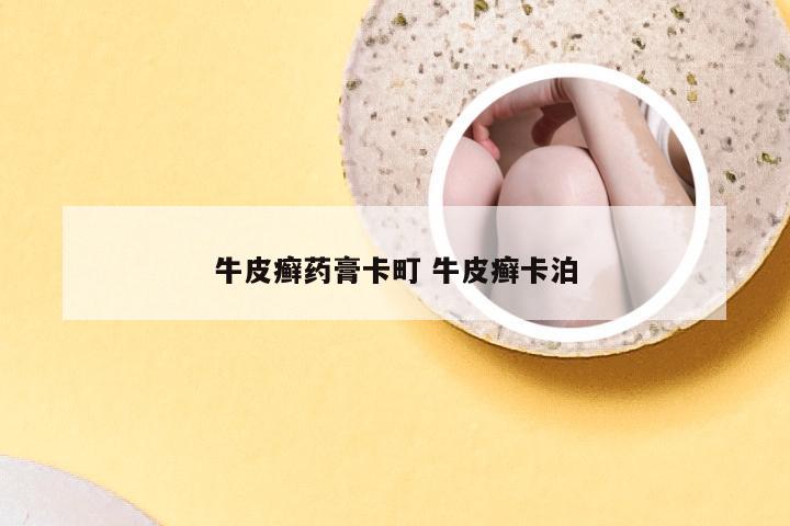 牛皮癣药膏卡町 牛皮癣卡泊