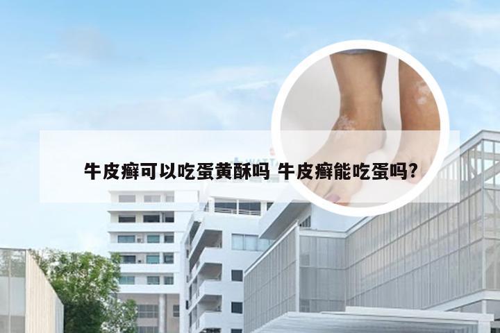 牛皮癣可以吃蛋黄酥吗 牛皮癣能吃蛋吗?