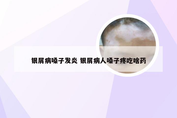 银屑病嗓子发炎 银屑病人嗓子疼吃啥药