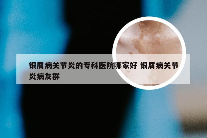 银屑病关节炎的专科医院哪家好 银屑病关节炎病友群