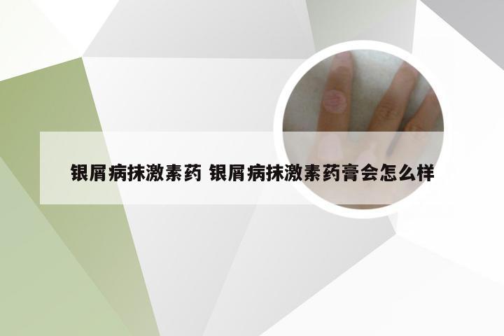 银屑病抹激素药 银屑病抹激素药膏会怎么样