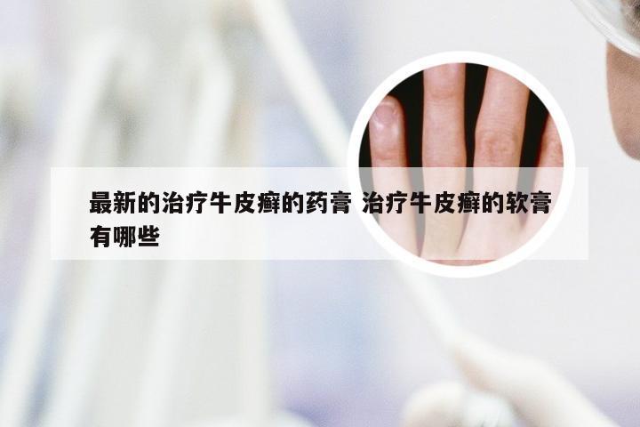 最新的治疗牛皮癣的药膏 治疗牛皮癣的软膏有哪些