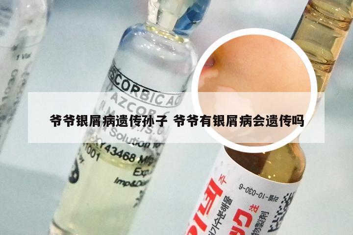 爷爷银屑病遗传孙子 爷爷有银屑病会遗传吗