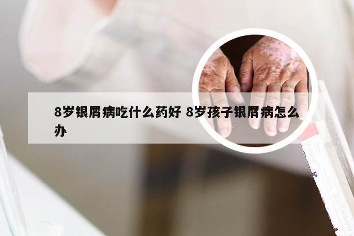 8岁银屑病吃什么药好 8岁孩子银屑病怎么办