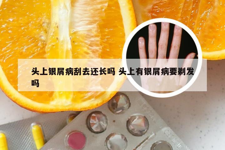 头上银屑病刮去还长吗 头上有银屑病要剃发吗