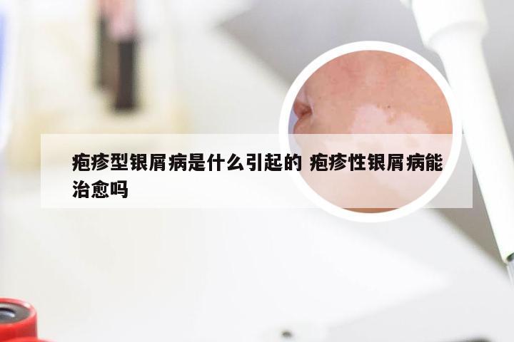 疱疹型银屑病是什么引起的 疱疹性银屑病能治愈吗