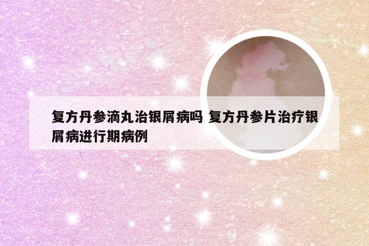 复方丹参滴丸治银屑病吗 复方丹参片治疗银屑病进行期病例