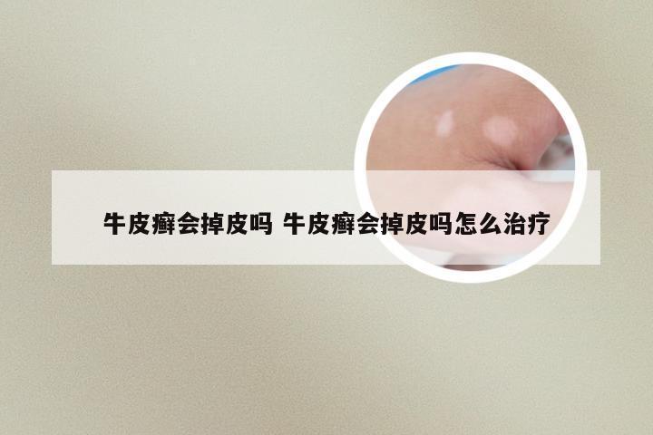 牛皮癣会掉皮吗 牛皮癣会掉皮吗怎么治疗