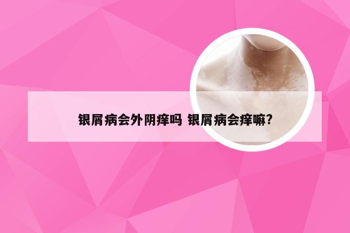 银屑病会外阴痒吗 银屑病会痒嘛?