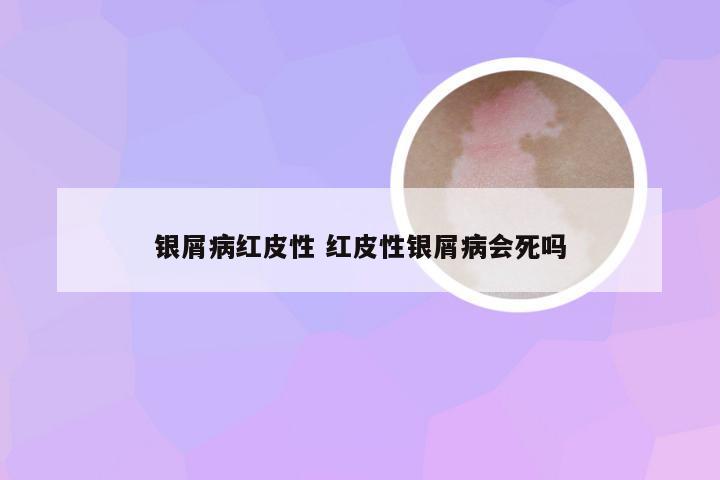 银屑病红皮性 红皮性银屑病会死吗