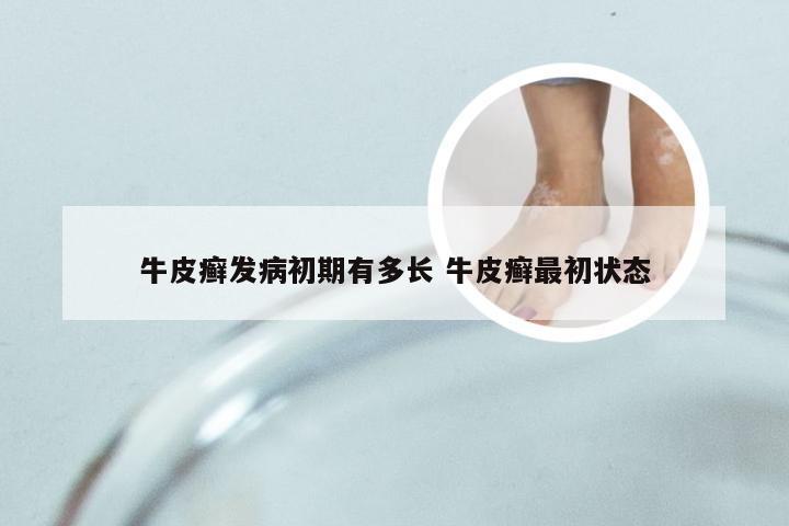 牛皮癣发病初期有多长 牛皮癣最初状态