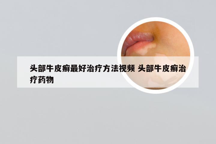 头部牛皮癣最好治疗方法视频 头部牛皮癣治疗药物