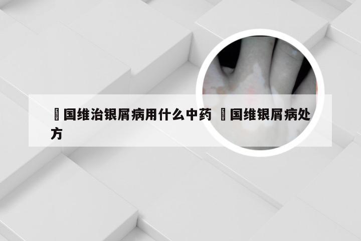 禤国维治银屑病用什么中药 禤国维银屑病处方