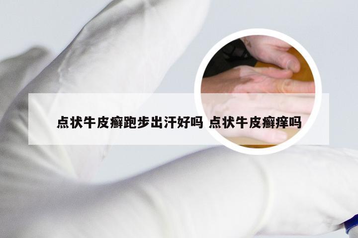 点状牛皮癣跑步出汗好吗 点状牛皮癣痒吗