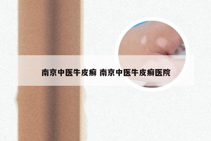 南京中医牛皮癣 南京中医牛皮癣医院