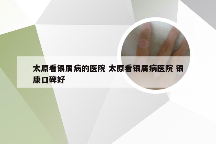 太原看银屑病的医院 太原看银屑病医院 银康口碑好