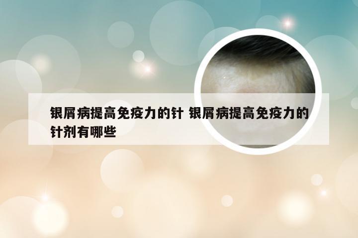 银屑病提高免疫力的针 银屑病提高免疫力的针剂有哪些