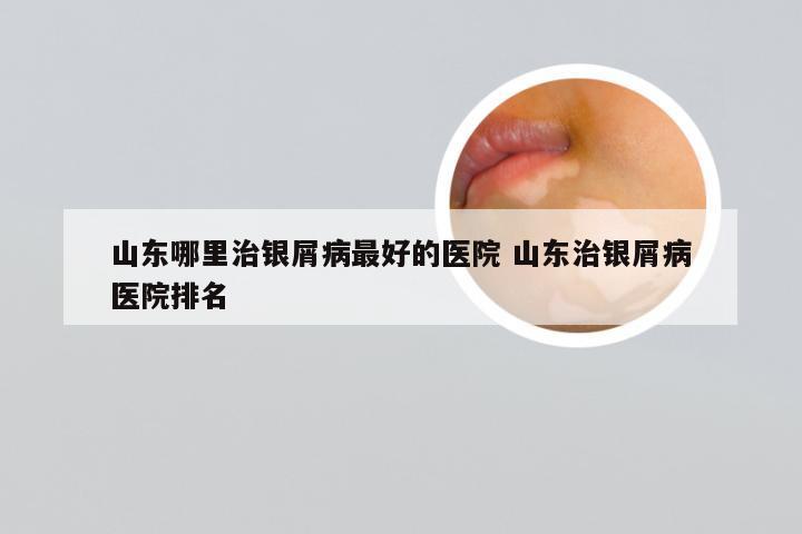 山东哪里治银屑病最好的医院 山东治银屑病医院排名