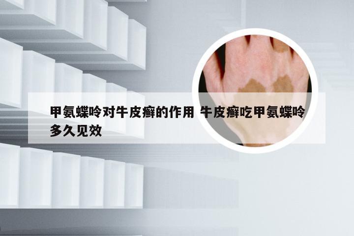 甲氨蝶呤对牛皮癣的作用 牛皮癣吃甲氨蝶呤多久见效