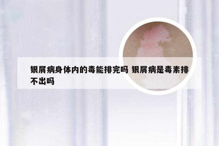 银屑病身体内的毒能排完吗 银屑病是毒素排不出吗