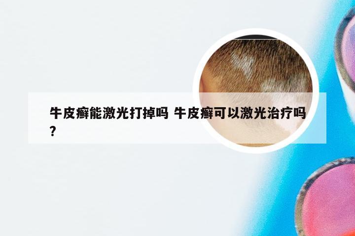 牛皮癣能激光打掉吗 牛皮癣可以激光治疗吗?