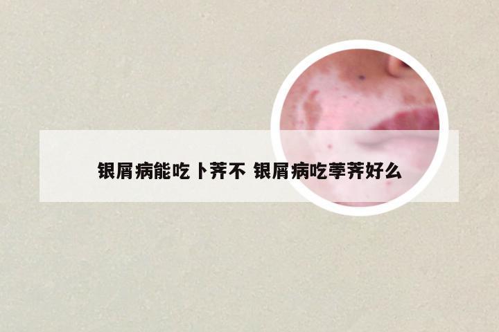 银屑病能吃卜荠不 银屑病吃荸荠好么