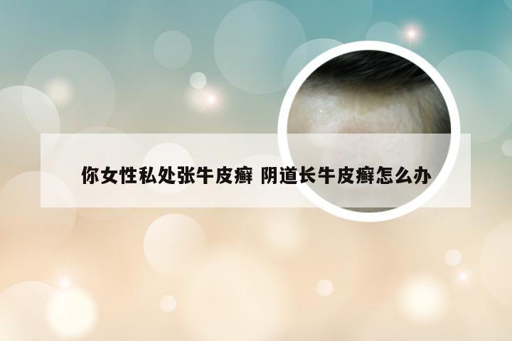 你女性私处张牛皮癣 阴道长牛皮癣怎么办