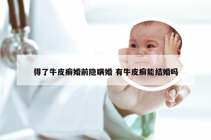 得了牛皮癣婚前隐瞒婚 有牛皮癣能结婚吗