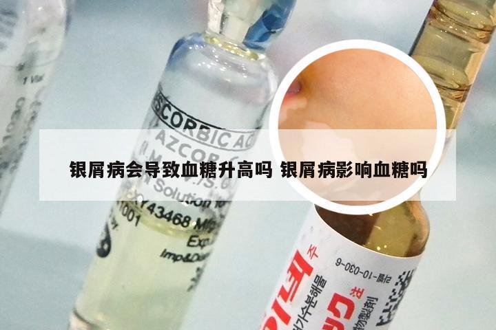 银屑病会导致血糖升高吗 银屑病影响血糖吗