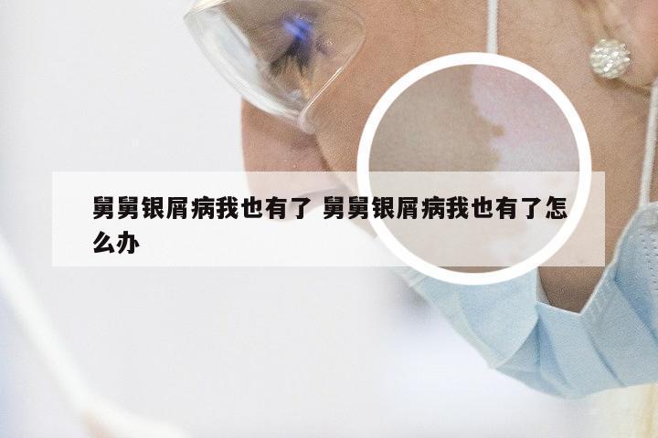 舅舅银屑病我也有了 舅舅银屑病我也有了怎么办