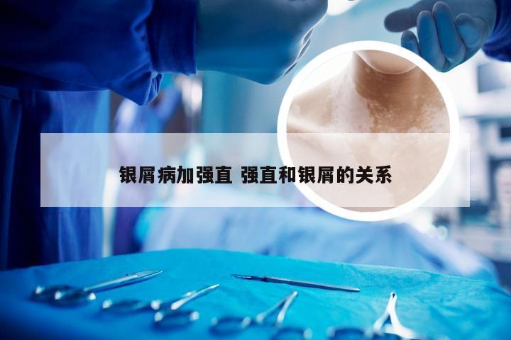 银屑病加强直 强直和银屑的关系