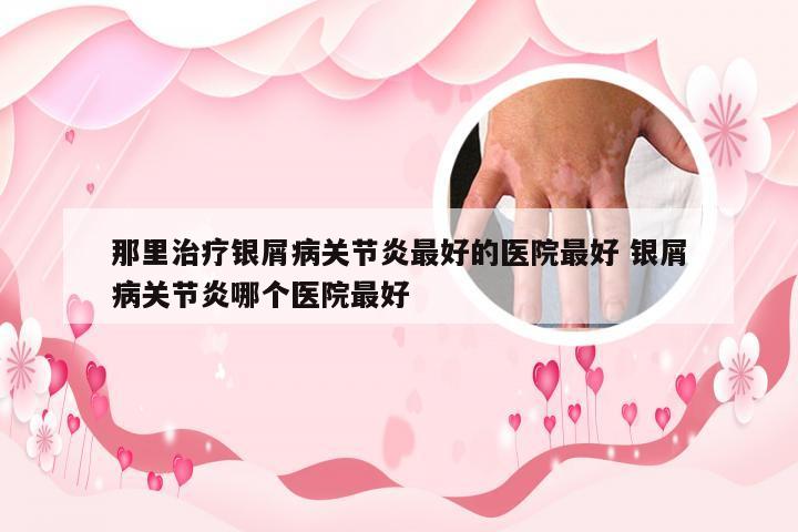 那里治疗银屑病关节炎最好的医院最好 银屑病关节炎哪个医院最好