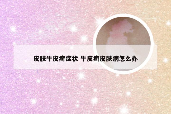 皮肤牛皮癣症状 牛皮癣皮肤病怎么办