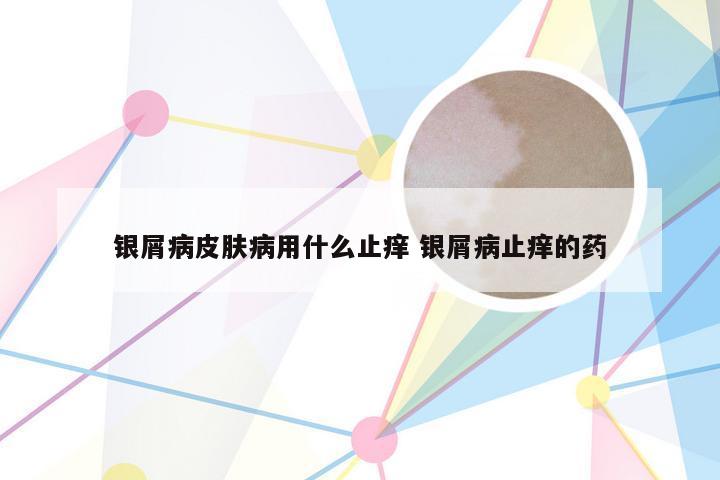 银屑病皮肤病用什么止痒 银屑病止痒的药