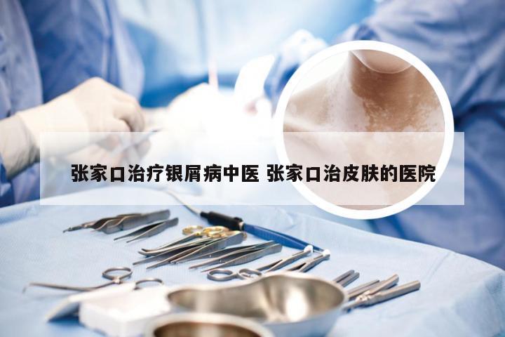 张家口治疗银屑病中医 张家口治皮肤的医院
